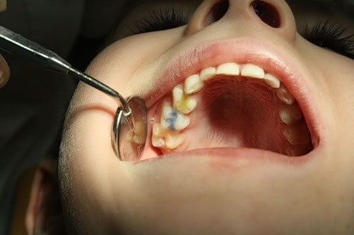 Герметизация фиссур зубов в детском возрасте