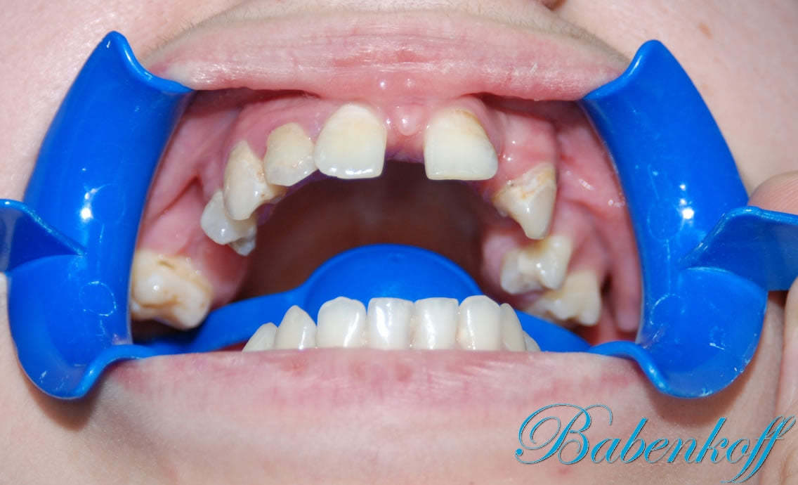 Частичное отсутствие зубов, дистопия зубов верхней челюсти