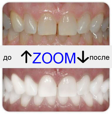 Отбеливание зубов ZOOM-4