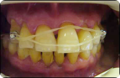 Шинирование зубов протезами